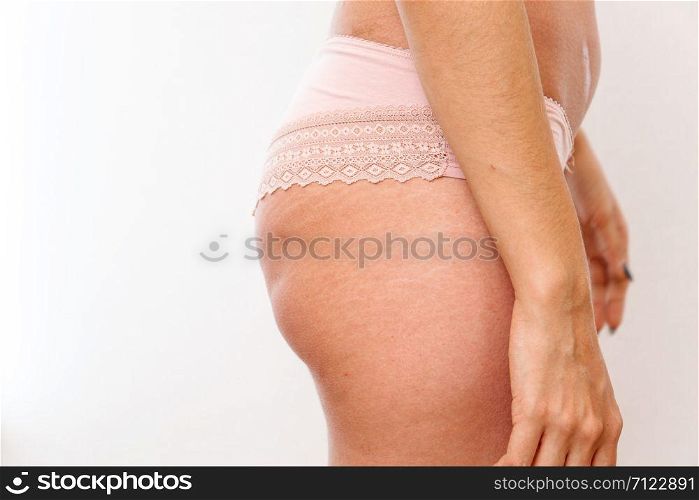 young woman shows her buttocks with cellulite and stretch marks on white isolated background. concept for medicine and cosmetology/