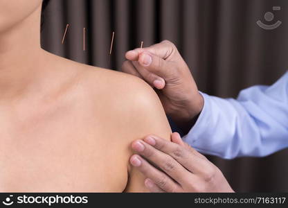 young woman undergoing acupuncture treatment on shoulder