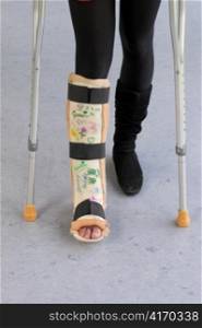 young woman with leg in plaster
